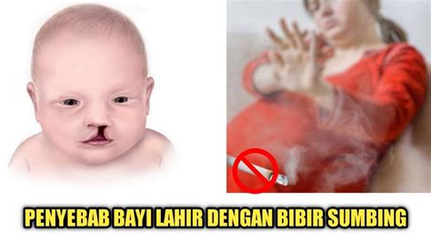 Penyebab Bayi Lahir Dengan Bibir Sumbing Ibu Hamil Wajib Tahu Youtube
