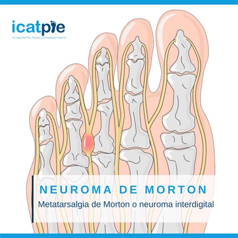 Neuroma De Morton Síntomas Causas Y Tratamiento