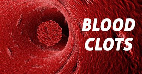 Signs And Symptoms Of Blood Clots Elite Medical Center