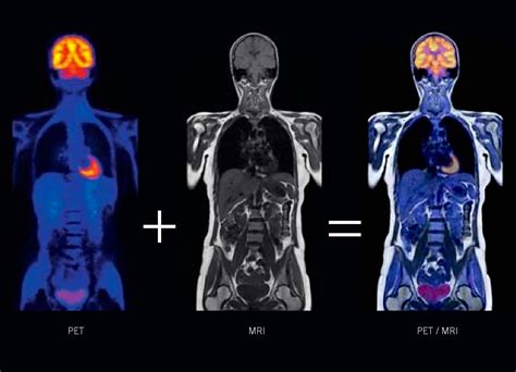 How Do Pet Scans Differ From Mri Scans For Neuroendocrine Cancer