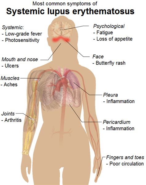 Systemic Lupus Erythematosus Symptoms Diagnosis Causes Treatment