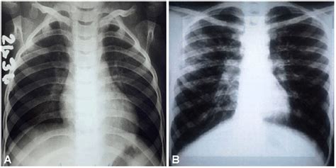 Radiological Aspects In Cf Chest Radiographs In Postero Anterior