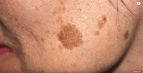We All Have Brown Spots Otherwise Known As Age Spots Somewhere On Our