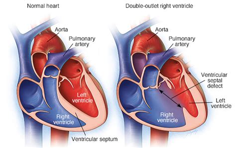 Double Outlet Right Ventricle Repair Surgery And Survival Rate