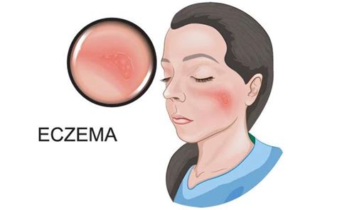 How To Treat Eczema Causes Symptoms Prevention And 5 Different Types