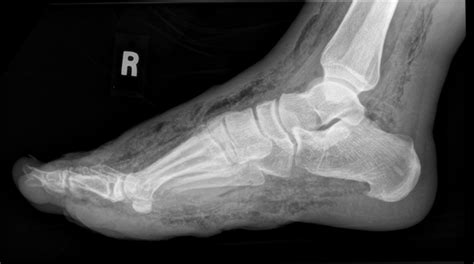 Necrotising Faciitis In A Diabetic Foot Radiology Case Radiopaedia
