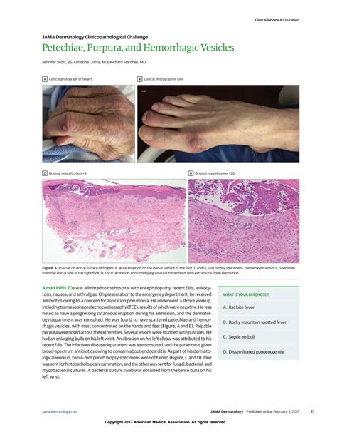 Petechiae Purpura And Hemorrhagic Vesicles Dermatology Jama