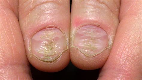Strefa Piękna Zaburzenia wyglądu i kształtu paznokci