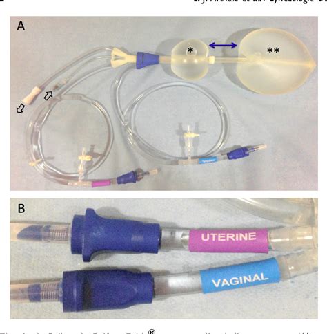 Figure 1 From [how I Do Intrauterine Balloon Tamponade For Postpartum Haemorrhage