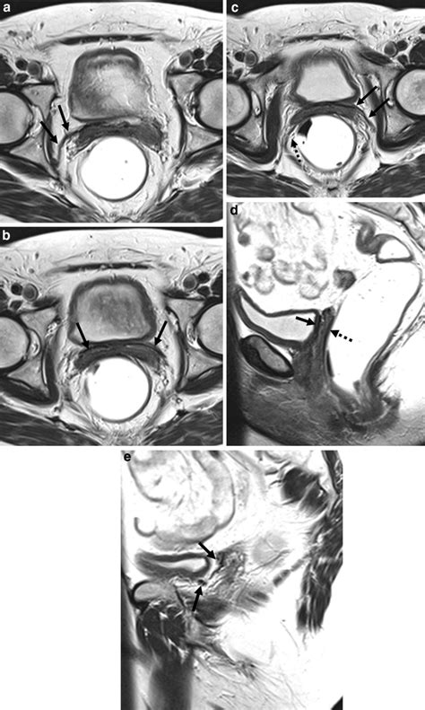 Axial T Weighted T W Images A B C In A Year Old Female With Download Scientific