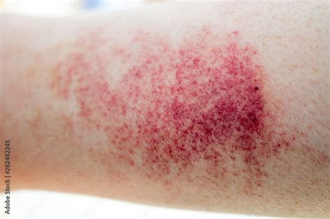 Red Rash Or Wound On Human Leg Skin Cause To Determined By A Doctor