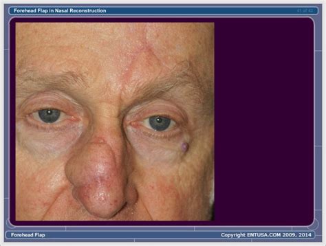 Nasal Skin Basal Cell Carcinoma Forehead Flap HTML5