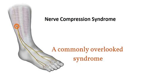 Nerve Compression Syndrome Cause Symptoms Treatment