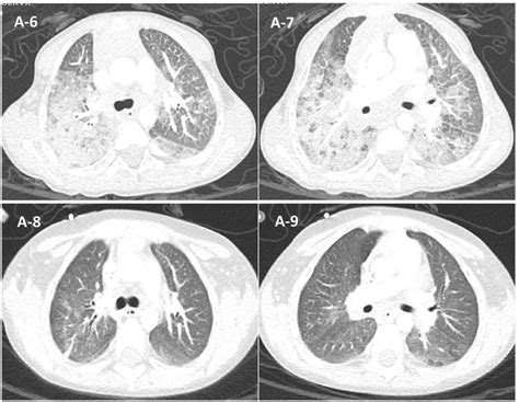 Chest Ct Of Patient A A 6 A 7 Discovery Of Infiltrative Lung