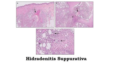 Hidradenitis Suppurativa 4 Symptoms Causes Risk Factors Diagnosis