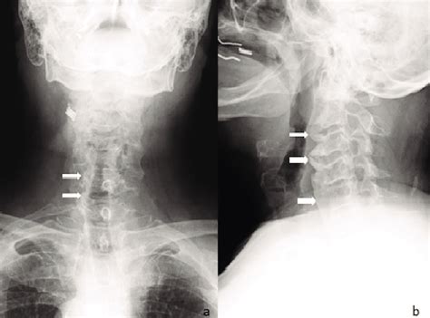 A Anteroposterior And B Lateral Radiographs Of Cervical Spine Show