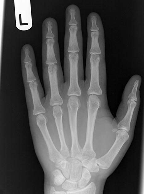 4th Metacarpal Fracture Importance Of 2 Views Radiology Case