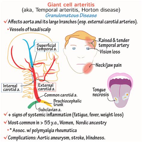 Temporalgiant Cell Arteritis Medizzy