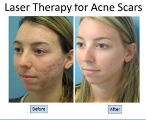 Scar revision involves surgically removing an old scar and treating the new scar with embrace scar therapy, laser resurfacing, or injections. Quality Cream For zits Scars On Face - Beast Lover