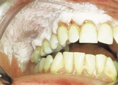 Proliferative Verrucous Leukoplakia Report Of A Case With