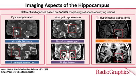 Imaging Aspects Of The Hippocampus Radiographics
