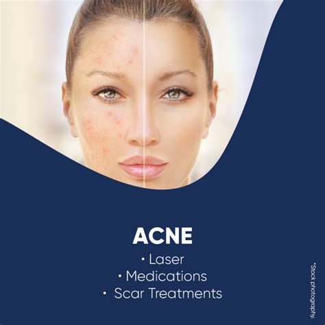 Acne Treatments Chatswood Aurora Dermatology