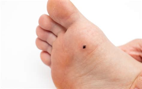 Foot Plantar Warts Removal By Steady Gait Foot Clinic In Scarborough