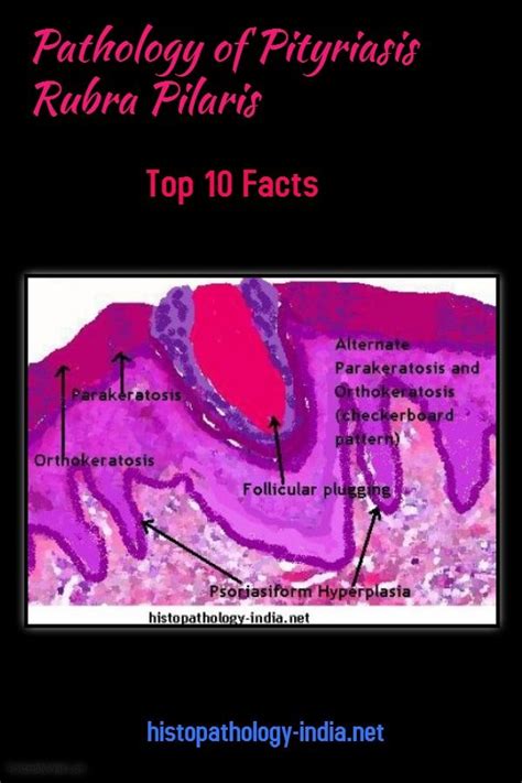 Pathology Of Pityriasis Rubra Pilaris Top 10 Facts Dermatopathology