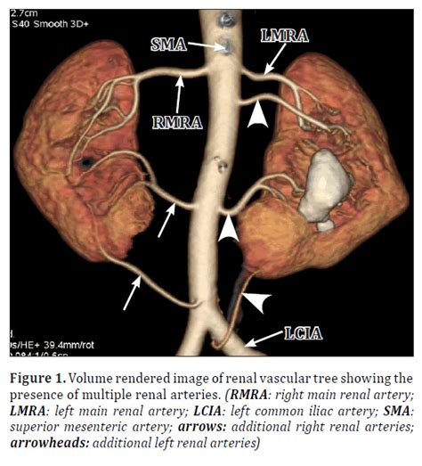 Mdct Angiographic Evaluation Of Multiple Renal Arteries A Case Report