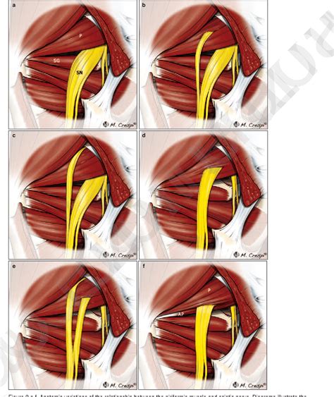 Figure From Deep Gluteal Space Problems Piriformis Vrogue Co