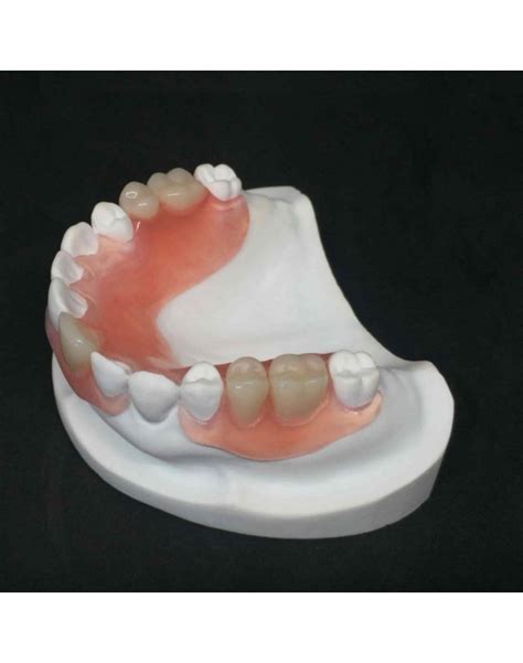 Immediate Acrylic Removable Partial Prosthesis Immediate Acrylic