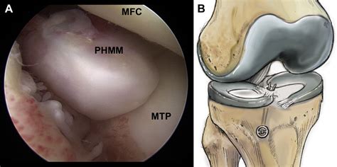 Arthroscopic Transtibial Pullout Repair For Posterior Medial Meniscus Root Tears A Systematic