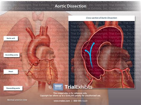Aortic Dissection Trialexhibits Inc