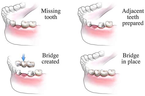 Dental Bridges Alrewas Dental Practice Near Burton On Trent