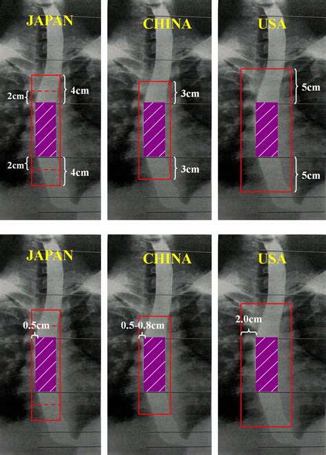 Determination Of Radiotherapy Target Volume For Esophageal Cancer Liu