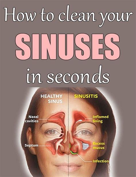 Quick Way To Clear Up Sinuses Anna Blog