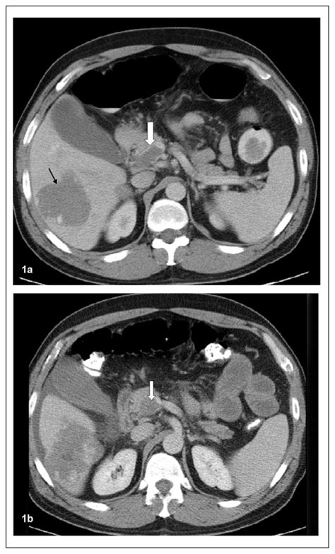 Splenic And Superior Mesenteric Artery Thrombolytic Infusion Therapy