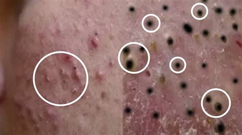 Blackheads Milia Big Cystic Acne Blackheads Extraction Whiteheads Removal Pimple Popping