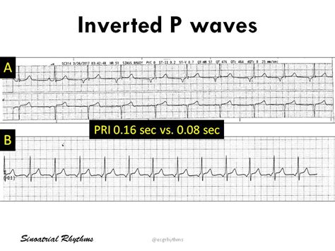 Inverted P Waves A Ectopic Atrial Rhythm B Junctional Grepmed