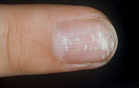 Leukonychia Symptoms Causes Striata Punctata Treatment Pictures