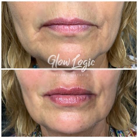 Hyaluronic Acid Lip Fillers Before And After Before And After