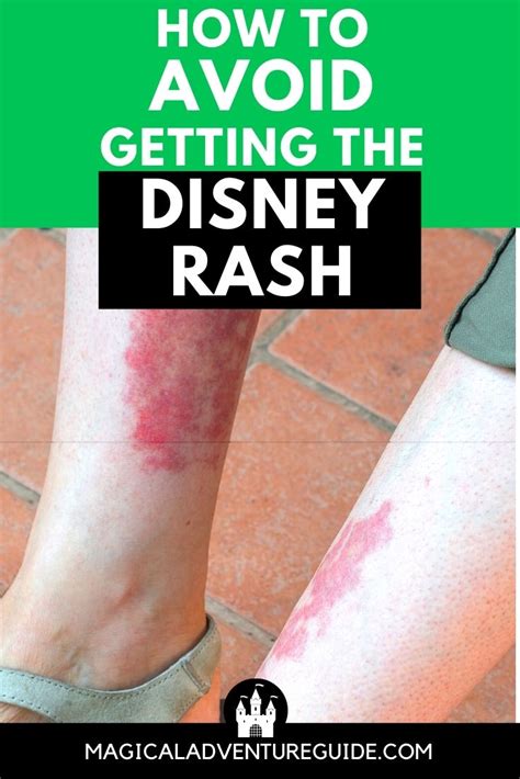 The Disney Rash A Nurses Tips For Preventing And Treating It
