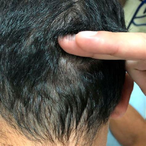 Occipital Scalp Eschar Surrounded By Erythematous Halo With
