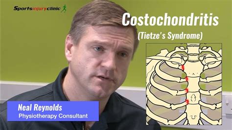 Costochondritis Tietze S Syndrome Explained YouTube