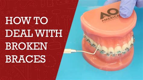 How To Fix Broken Braces Orthodontics Tips Orthodontics