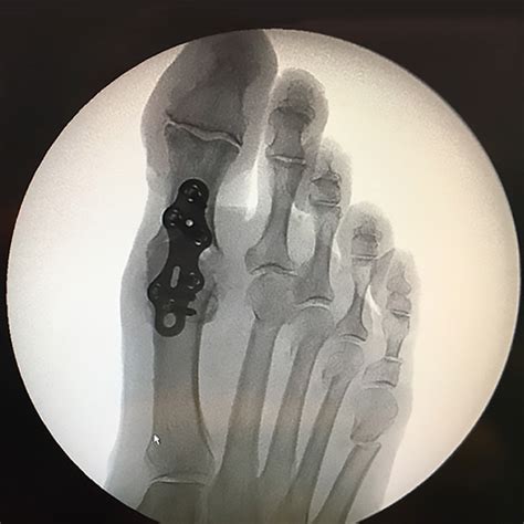 Traitement et chirurgie de l avant pied l hallux rigidus UNITÉ DE CHIRURGIE DU PIED ET DE LA