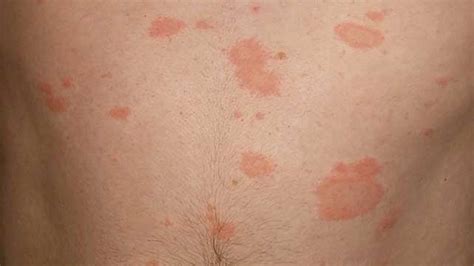 Heat Itchy Rash Pictures Of Skin Rash Get Info On All Types Of