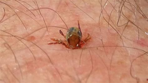 Lyme Disease Tick Bite Mcmanus Northern Beaches Daily Telegraph