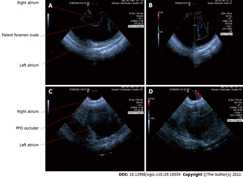 Novel Way Of Patent Foramen Ovale Detection And Percutaneous Closure By