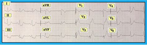 Quadruple nosepiece revolves on ball bearing. ECG Interpretation: ECG Interpretation Review #53 (Peaked ...